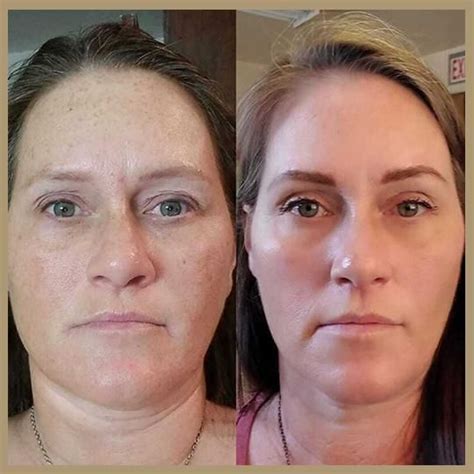 fascia blasting before and after face|More.